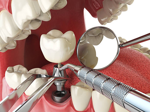 Best Broken Tooth Emergency  in Grass Lake, MI